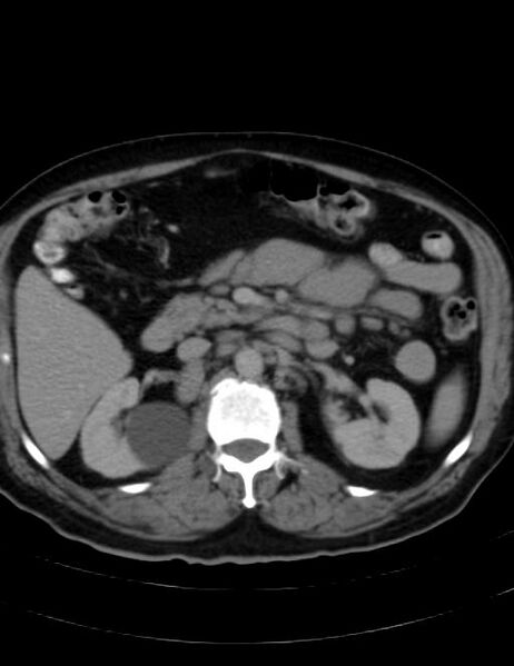 File:Abdominal lymphoma - with sandwich sign (Radiopaedia 53486-59492 Axial C+ portal venous phase 20).jpg