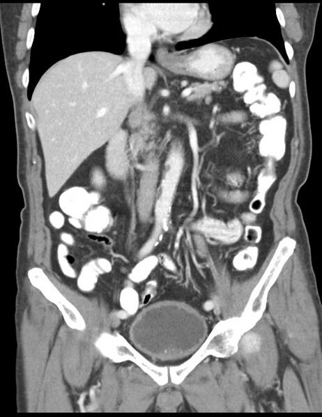 File:Abdominal wall metastasis from colorectal carcinoma (Radiopaedia 31016-31717 Coronal C+ portal venous phase 23).jpg
