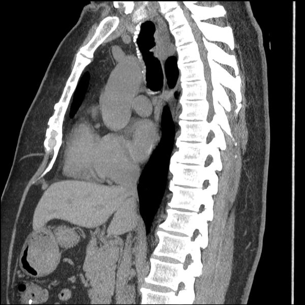 File:Aberrant right subclavian artery (Radiopaedia 40967-43680 Sagittal non-contrast 48).jpg