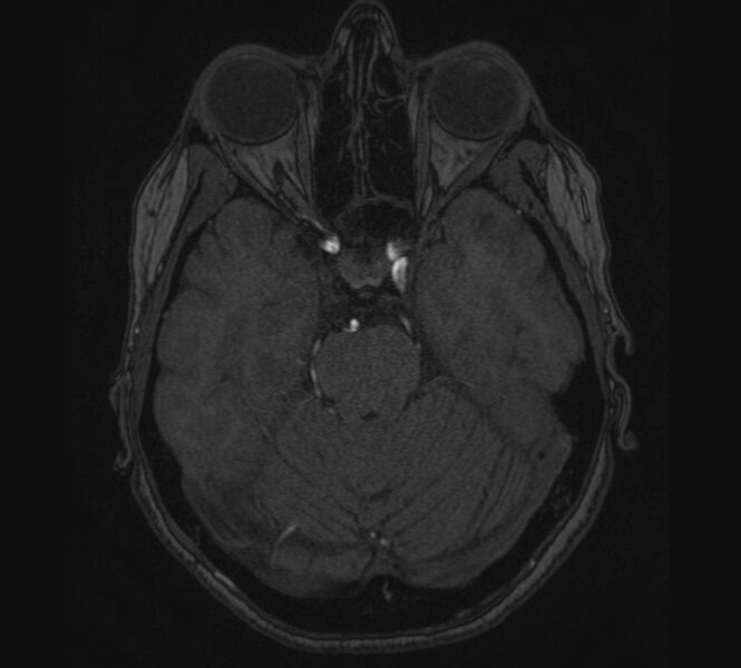 File:Accessory middle cerebral artery and ICA aneurysm (Radiopaedia 22656-22674 MRA 32).jpg