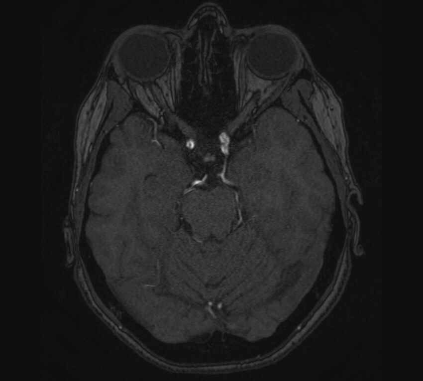 Accessory middle cerebral artery and ICA aneurysm (Radiopaedia 22656-22674 MRA 37).jpg