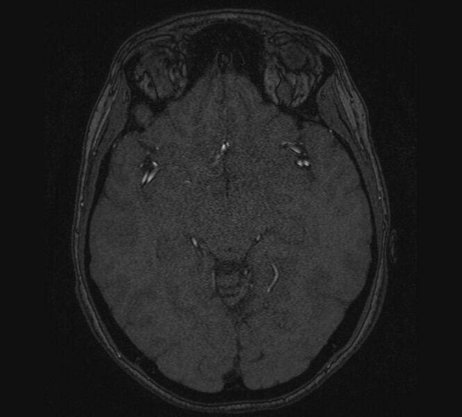 File:Accessory middle cerebral artery and ICA aneurysm (Radiopaedia 22656-22674 MRA 59).jpg