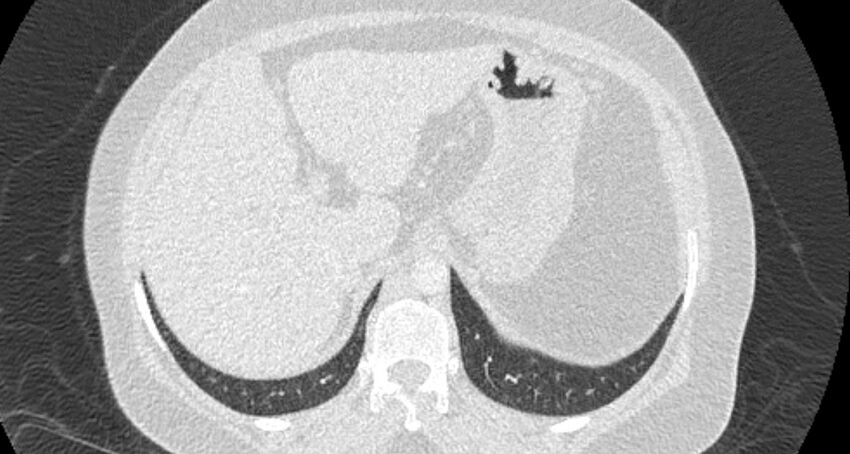 Accessory right inferior hepatic vein (Radiopaedia 65245-74259 Axial lung window 72).jpg