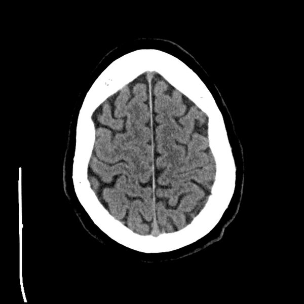 File:Acute A3 occlusion with ACA ischemic penumbra (CT perfusion) (Radiopaedia 72036-82525 Axial non-contrast 38).jpg