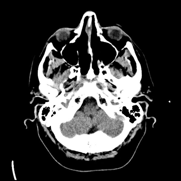 File:Acute A3 occlusion with ACA ischemic penumbra (CT perfusion) (Radiopaedia 72036-82525 Axial non-contrast 5).jpg