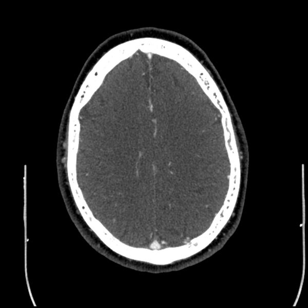 File:Acute A3 occlusion with ACA ischemic penumbra (CT perfusion) (Radiopaedia 72036-82527 Axial C+ arterial phase thins 9).jpg