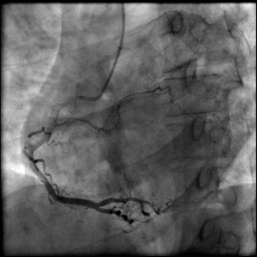 Acute anteroseptal myocardial infarction (Radiopaedia 68409-77946 RAO straight RCA 44).jpg