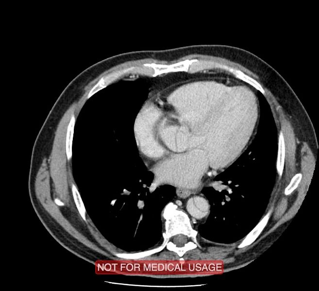 File:Acute aortic dissection - Stanford type A (Radiopaedia 40661-43285 Axial C+ portal venous phase 35).jpg