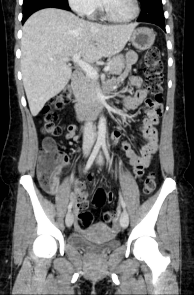File:Acute appendicitis (Radiopaedia 22892-22918 Coronal C+ portal venous phase 22).png