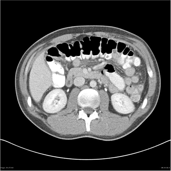 File:Acute appendicitis (Radiopaedia 25364-25615 B 24).jpg