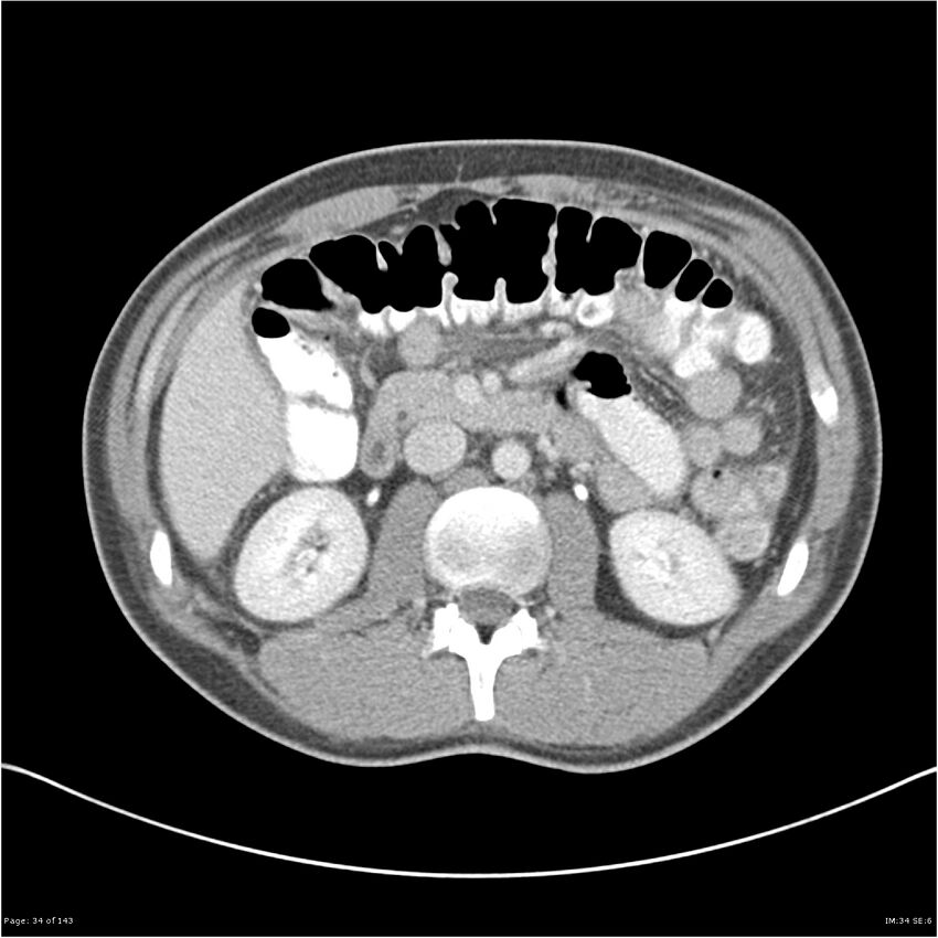 Acute appendicitis (Radiopaedia 25364-25615 B 24).jpg