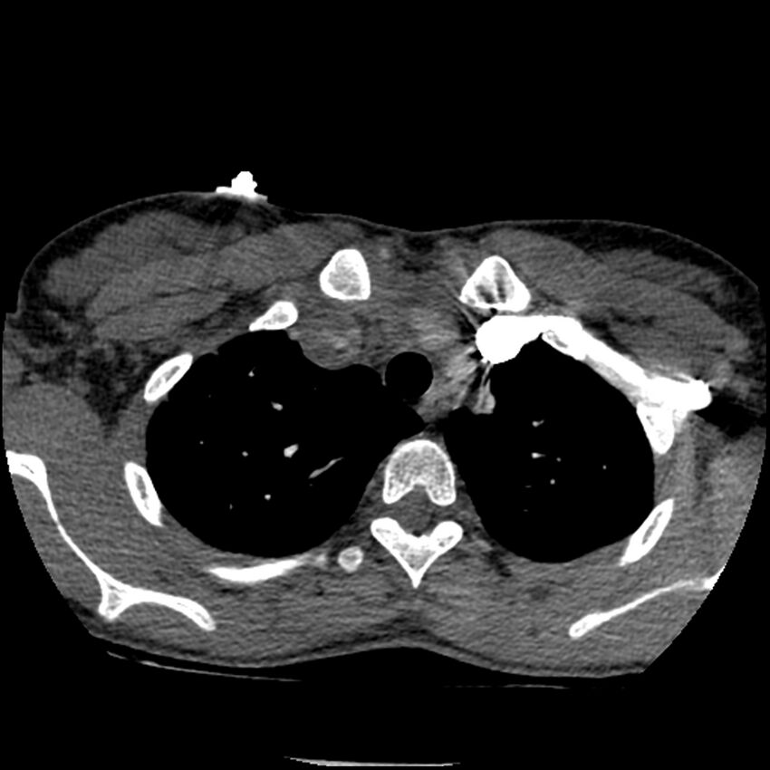 Acute chest syndrome - sickle cell disease (Radiopaedia 42375-45499 Axial C+ CTPA 37).jpg