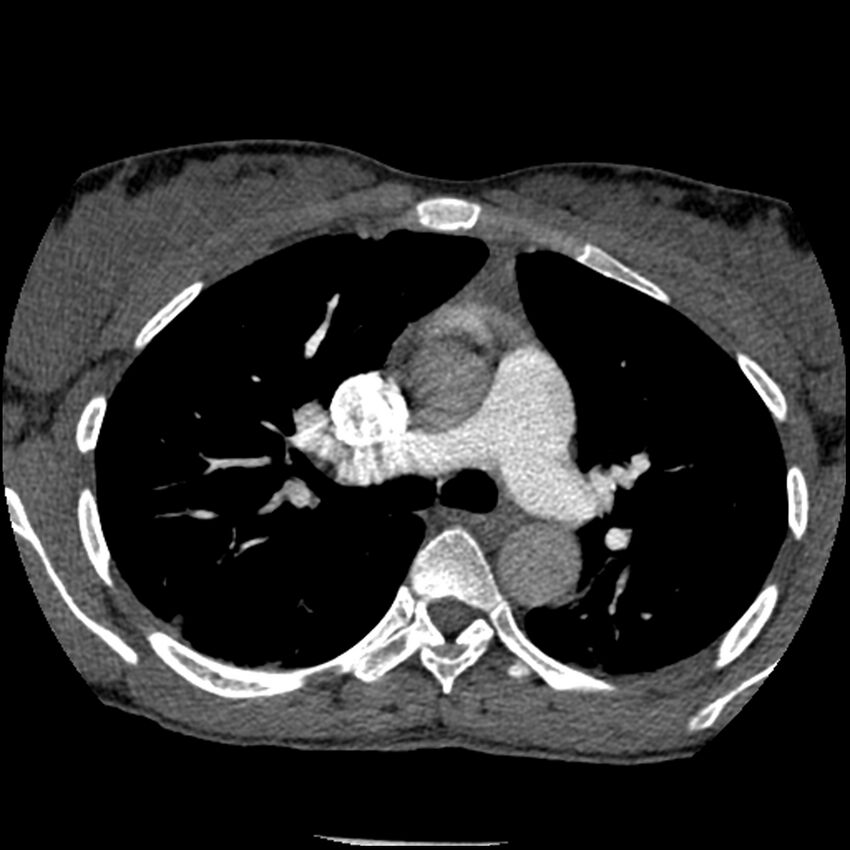 Acute chest syndrome - sickle cell disease (Radiopaedia 42375-45499 Axial C+ CTPA 71).jpg