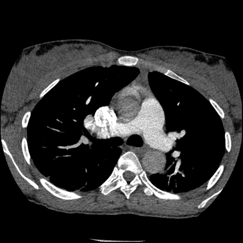 Acute chest syndrome - sickle cell disease (Radiopaedia 42375-45499 Axial C+ CTPA 72).jpg