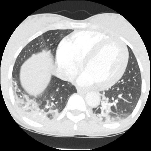 File:Acute chest syndrome - sickle cell disease (Radiopaedia 42375-45499 Axial lung window 137).jpg