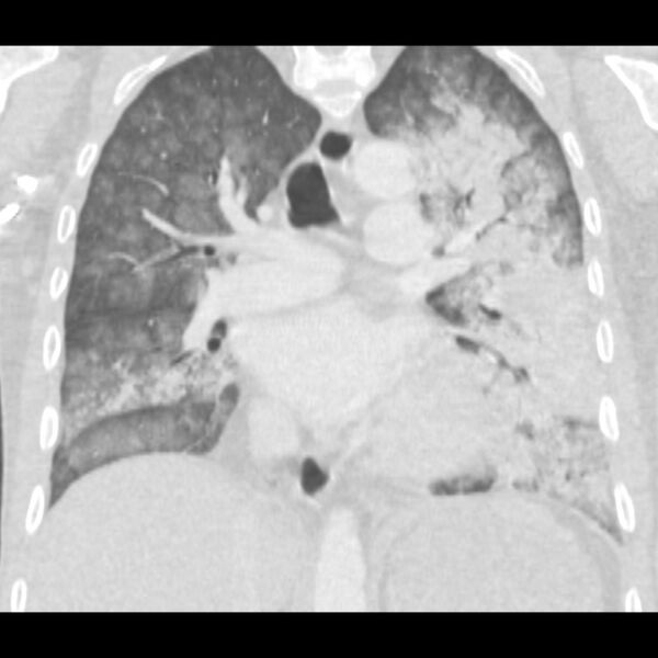 File:Acute diffuse alveolar hemorrhage (Radiopaedia 41323-44158 Coronal lung window 28).jpg