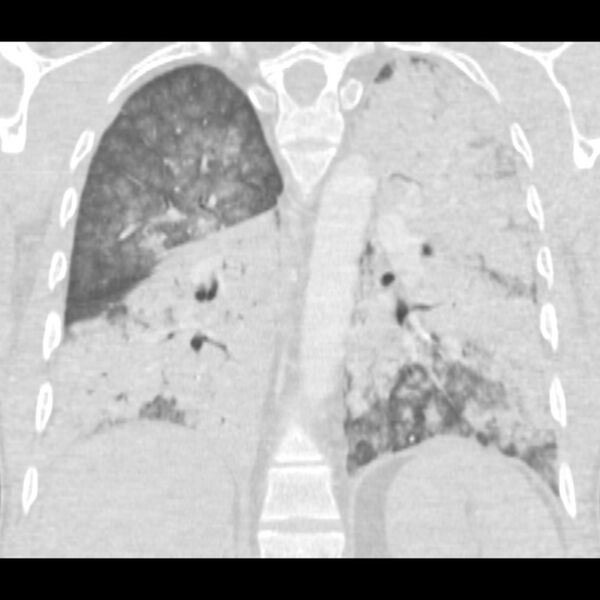 File:Acute diffuse alveolar hemorrhage (Radiopaedia 41323-44158 Coronal lung window 37).jpg