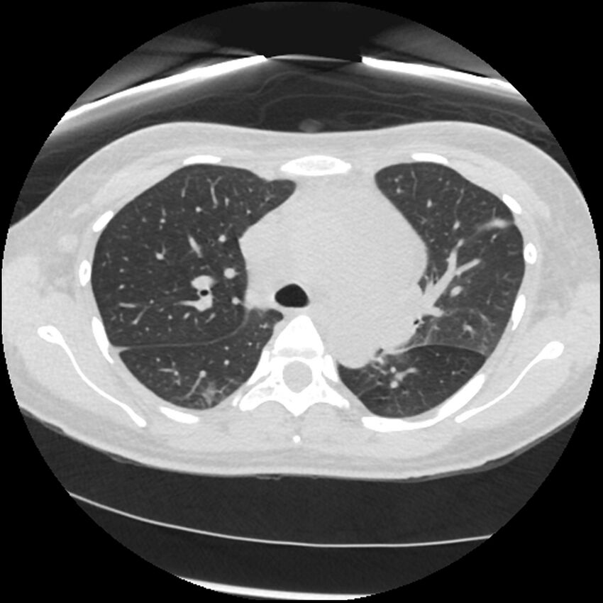 Acute lupus nephritis (Radiopaedia 45832-50107 Axial lung window 31).jpg