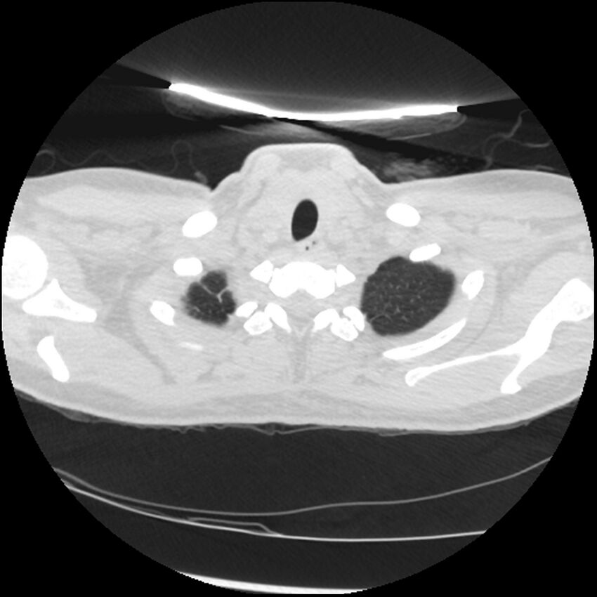 Acute lupus nephritis (Radiopaedia 45832-50107 Axial lung window 6).jpg