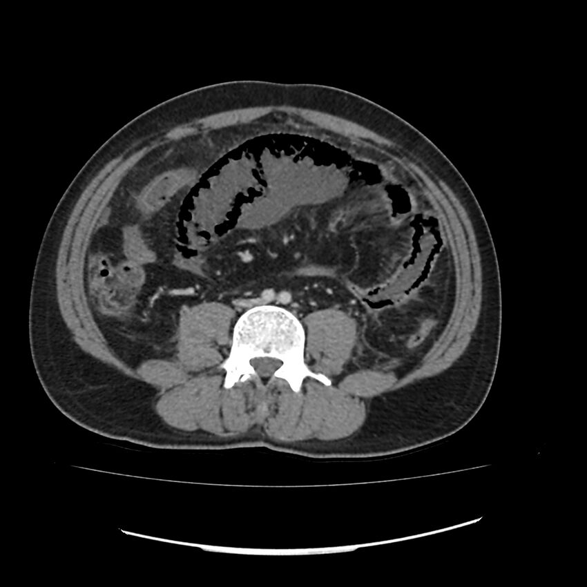 Acute mesenteric ischemia - superior mesenteric artery thrombosis (Radiopaedia 73947-84776 Axial C+ portal venous phase 93).jpg
