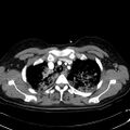 Acute myocardial infarction in CT (Radiopaedia 39947-42415 Axial C+ arterial phase 27).jpg