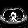 Acute myocardial infarction in CT (Radiopaedia 39947-42415 Axial C+ arterial phase 50).jpg