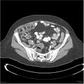 Acute pancreatitis (Radiopaedia 19136-19117 Axial C+ portal venous phase 33).jpg