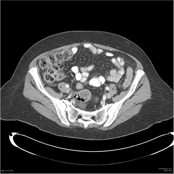 File:Acute pancreatitis (Radiopaedia 19136-19117 Axial C+ portal venous phase 33).jpg