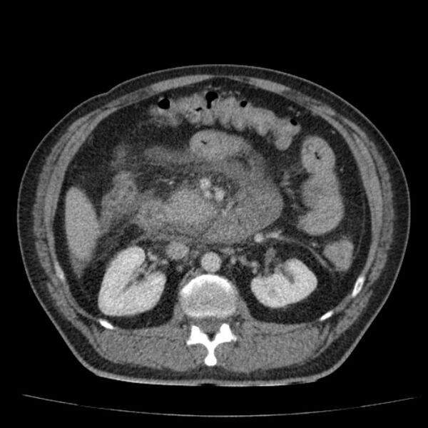 File:Acute pancreatitis (Radiopaedia 26663-26813 Axial C+ portal venous phase 37).jpg