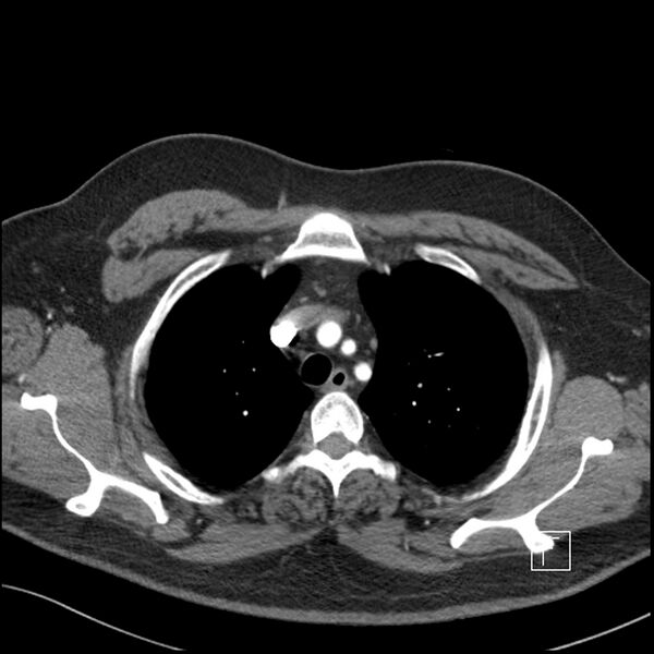 File:Acute pulmonary embolism with pulmonary infarct (Radiopaedia 73062-83768 Axial C+ CTPA 14).jpg