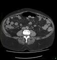 Acute renal failure post IV contrast injection- CT findings (Radiopaedia 47815-52557 Axial non-contrast 48).jpg