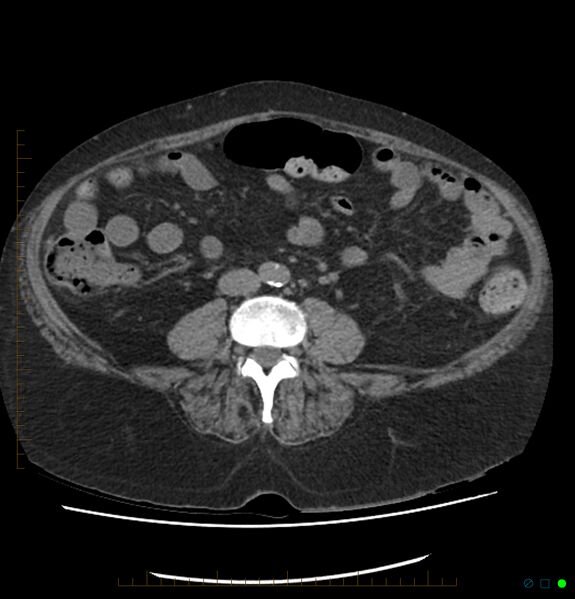 File:Acute renal failure post IV contrast injection- CT findings (Radiopaedia 47815-52557 Axial non-contrast 48).jpg