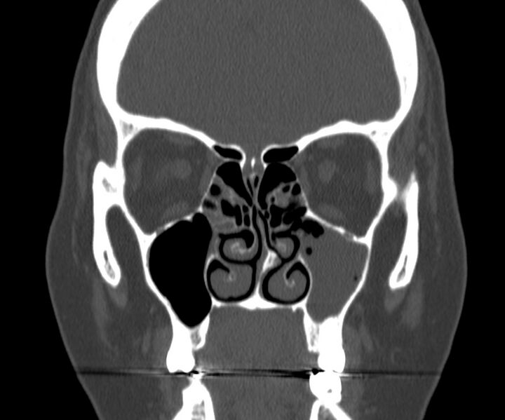 File:Acute sinusitis (Radiopaedia 22419-22455 Coronal bone window 17).jpg