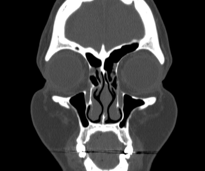File:Acute sinusitis (Radiopaedia 22419-22455 Coronal bone window 9).jpg