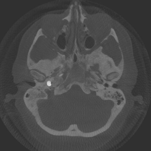 File:Acute subarachnoid hemorrhage and accessory anterior cerebral artery (Radiopaedia 69231-79010 Axial arterial - MIP 12).jpg