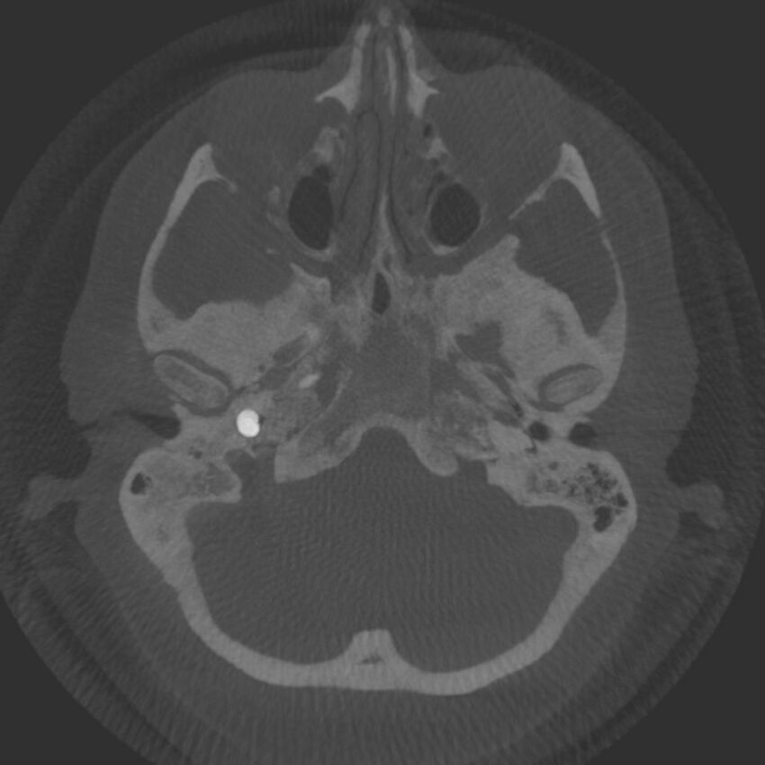 Acute subarachnoid hemorrhage and accessory anterior cerebral artery (Radiopaedia 69231-79010 Axial arterial - MIP 12).jpg