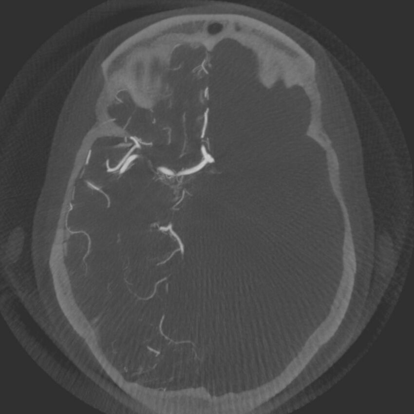 Acute subarachnoid hemorrhage and accessory anterior cerebral artery (Radiopaedia 69231-79010 Axial arterial - MIP 32).jpg
