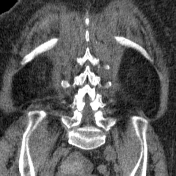 File:Acute tubular necrosis (Radiopaedia 28077-28334 Coronal non-contrast 32).jpg