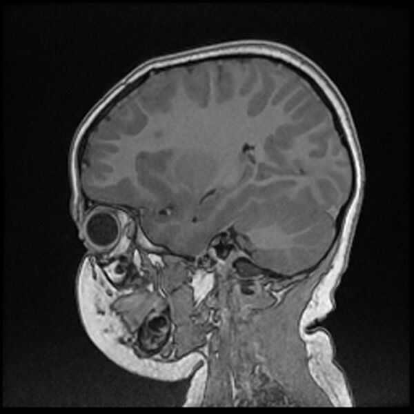 File:Adamantinomatous craniopharyngioma (Radiopaedia 77407-89529 Sagittal T1 C+ 91).jpg