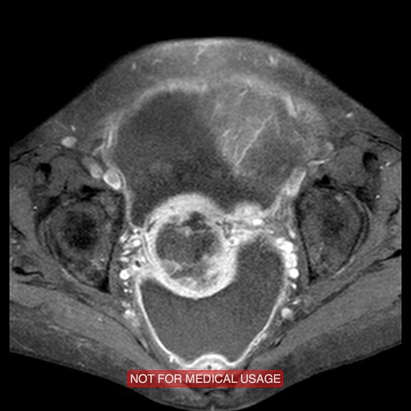 File:Adenocarcinoma of the cervix (Radiopaedia 28373-28615 Axial T1 C+ fat sat 10).jpg