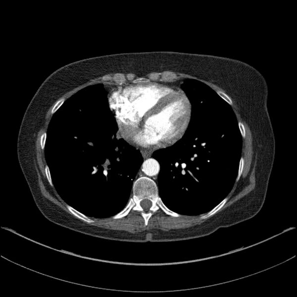 File:Adenocarcinoma of the lung (Radiopaedia 44205-47803 Axial C+ portal venous phase 58).jpg