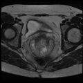 Adenoma malignum of the cervix (Radiopaedia 24460-24765 C 15).jpg
