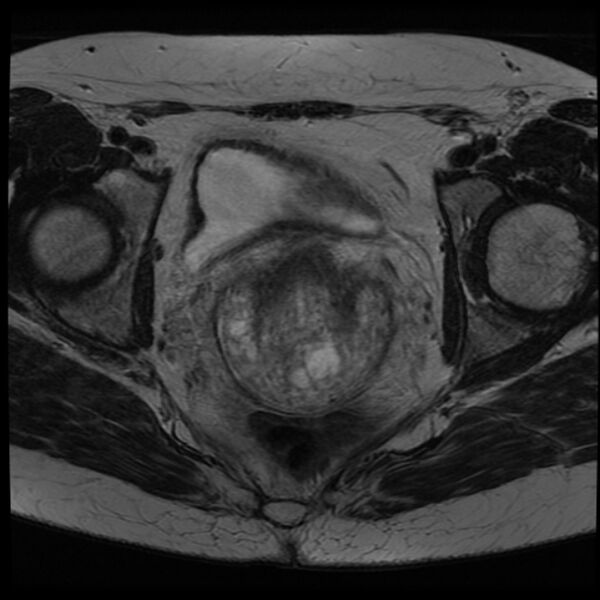 File:Adenoma malignum of the cervix (Radiopaedia 24460-24765 C 15).jpg