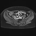 Adenomyosis and endometriotic cysts (Radiopaedia 82300-96367 Axial T1 C+ fat sat 24).jpg