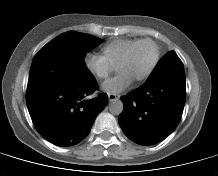 Adenosquamous lung carcinoma (Radiopaedia 22035-22030 non-contrast 39).jpg