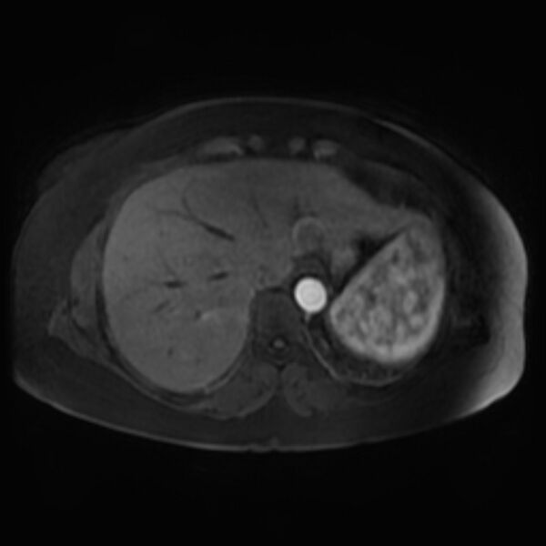 File:Adrenal cortical carcinoma (Radiopaedia 70906-81116 Axial Postcontrast-Dyn T1 fat sat 7).jpg