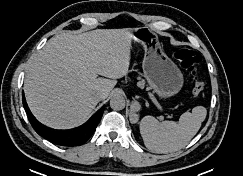File:Adrenal metastases (Radiopaedia 73082-83791 Axial non-contrast 33).jpg