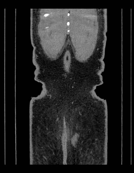 File:Adrenal myelolipoma - bilateral (Radiopaedia 74805-85810 Coronal C+ portal venous phase 40).jpg