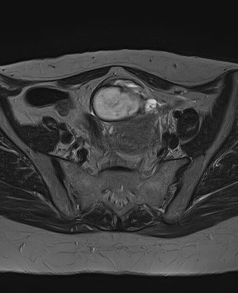 File:Adult granulosa cell tumor of the ovary (Radiopaedia 71581-81950 Axial T2 10).jpg