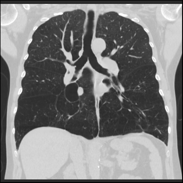 File:Alpha-1-antitrypsin deficiency (Radiopaedia 40993-43722 Coronal lung window 55).jpg
